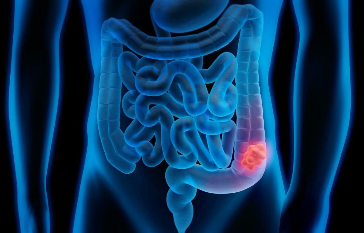 cancer colorectal