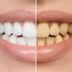dents jaunis